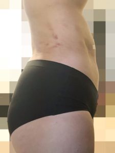 脂肪吸引1日目