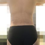 脂肪吸引　２日目